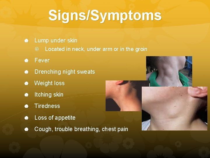 Signs/Symptoms Lump under skin Located in neck, under arm or in the groin Fever