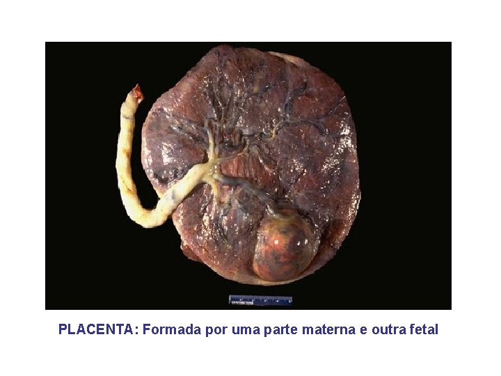 PLACENTA: Formada por uma parte materna e outra fetal 