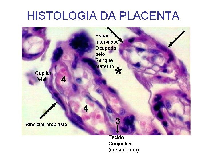 HISTOLOGIA DA PLACENTA Espaço Interviloso Ocupado pelo Sangue materno Capilar fetal Sinciciotrofoblasto Tecido Conjuntivo