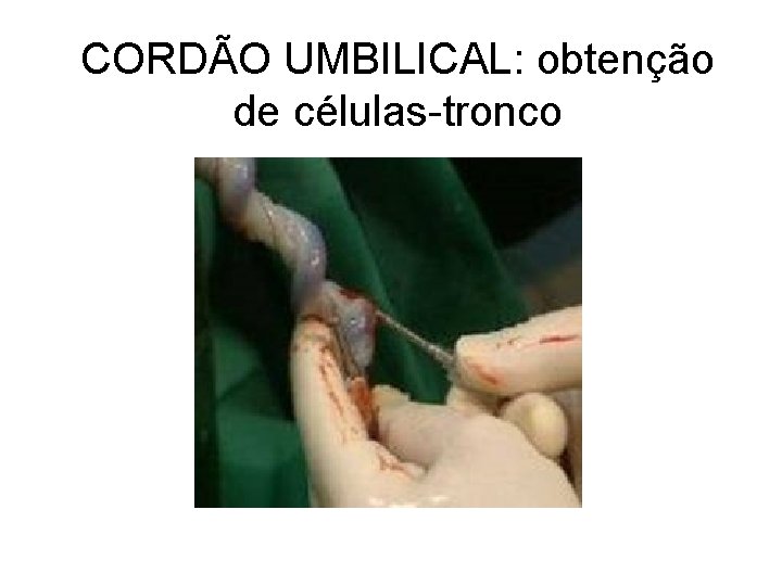 CORDÃO UMBILICAL: obtenção de células-tronco 