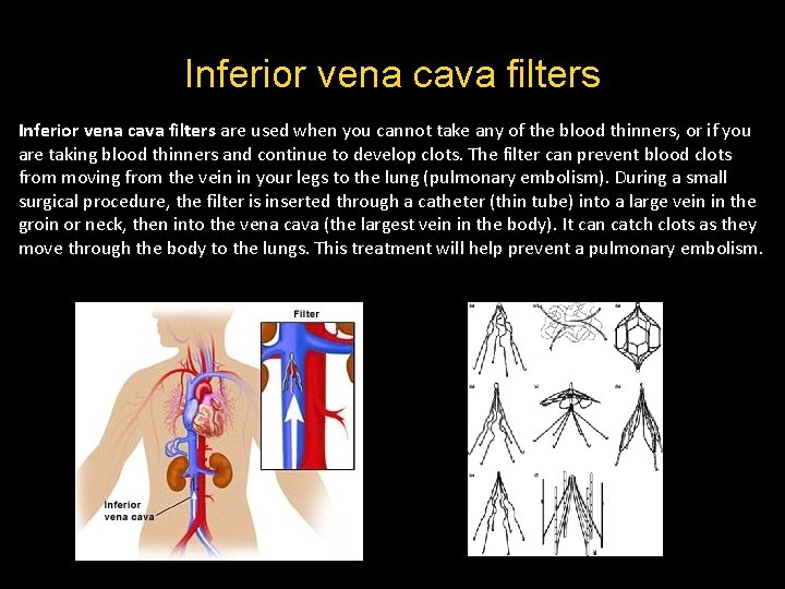 Inferior vena cava filters are used when you cannot take any of the blood Inferior vena cava filters are used when you cannot take any of the blood
