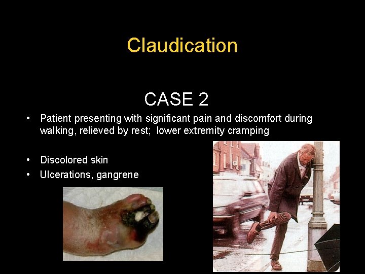 Claudication CASE 2 • Patient presenting with significant pain and discomfort during walking, relieved Claudication CASE 2 • Patient presenting with significant pain and discomfort during walking, relieved