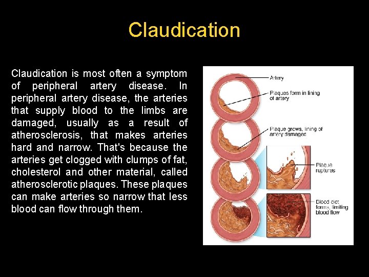 Claudication is most often a symptom of peripheral artery disease. In peripheral artery disease, Claudication is most often a symptom of peripheral artery disease. In peripheral artery disease,