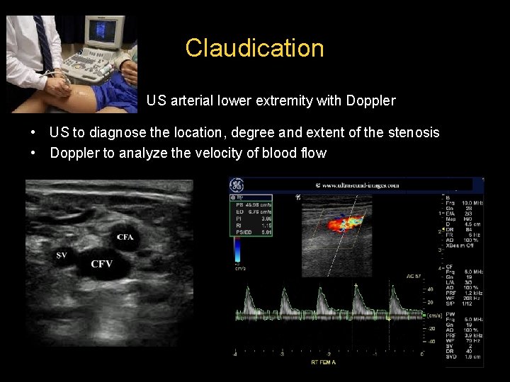 Claudication US arterial lower extremity with Doppler • US to diagnose the location, degree Claudication US arterial lower extremity with Doppler • US to diagnose the location, degree