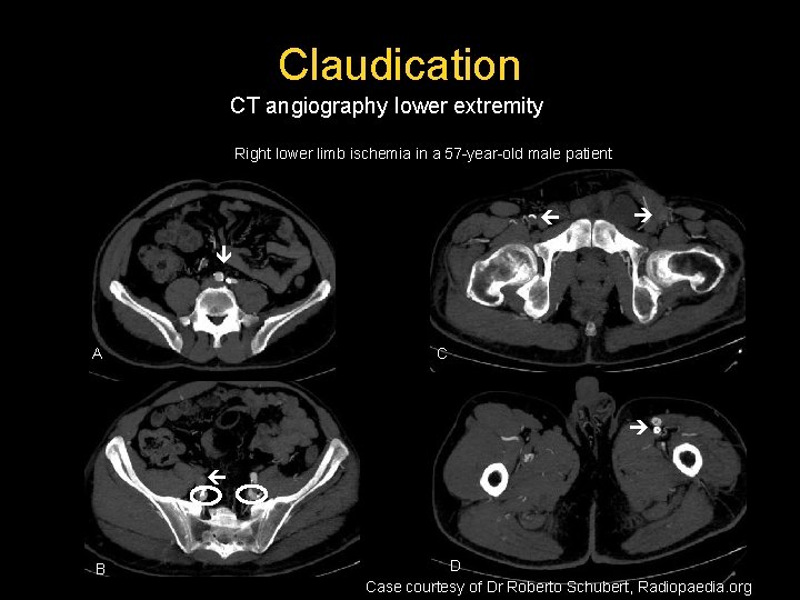 Claudication CT angiography lower extremity Right lower limb ischemia in a 57 -year-old male Claudication CT angiography lower extremity Right lower limb ischemia in a 57 -year-old male