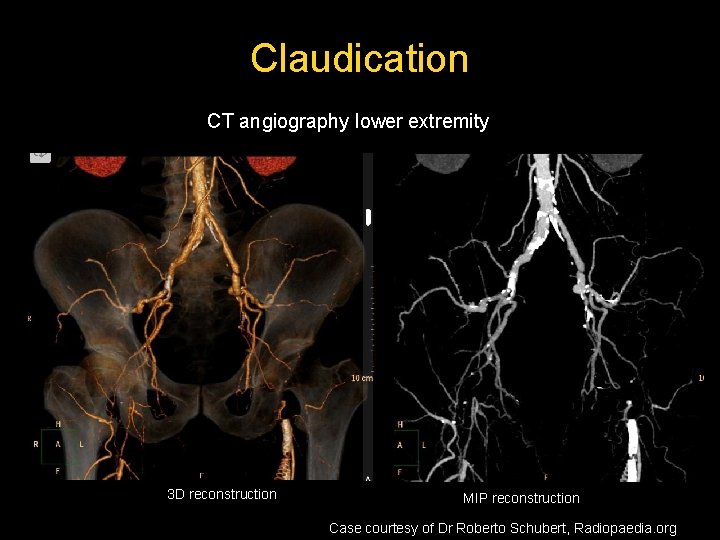 Claudication CT angiography lower extremity 3 D reconstruction MIP reconstruction Case courtesy of Dr Claudication CT angiography lower extremity 3 D reconstruction MIP reconstruction Case courtesy of Dr