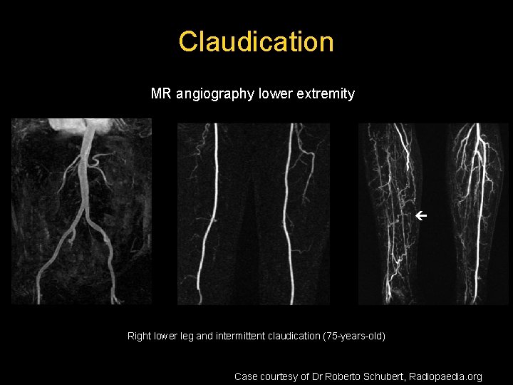 Claudication MR angiography lower extremity Right lower leg and intermittent claudication (75 -years-old) Case Claudication MR angiography lower extremity Right lower leg and intermittent claudication (75 -years-old) Case