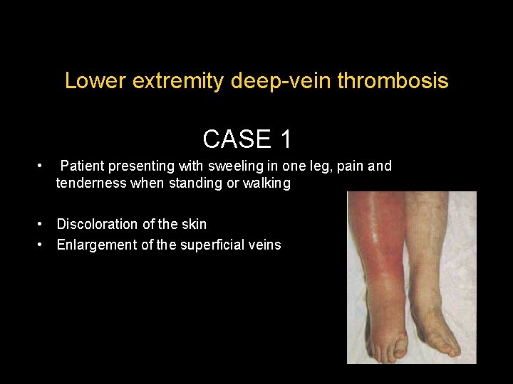 Lower extremity deep-vein thrombosis CASE 1 • Patient presenting with sweeling in one leg, Lower extremity deep-vein thrombosis CASE 1 • Patient presenting with sweeling in one leg,