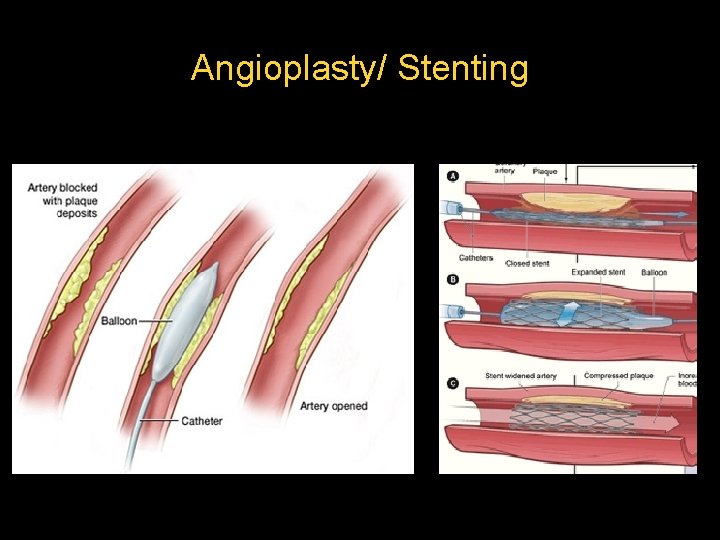 Angioplasty/ Stenting  Angioplasty/ Stenting
