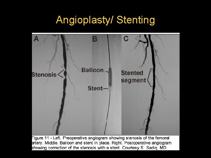 Angioplasty/ Stenting  Angioplasty/ Stenting