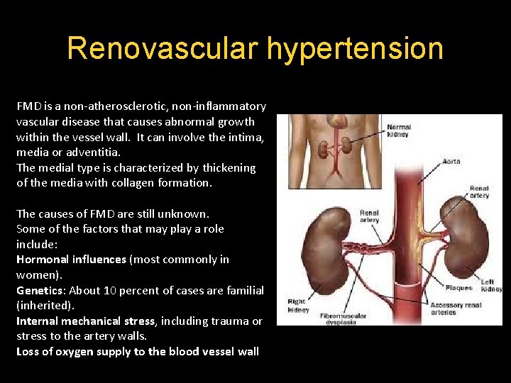 Renovascular hypertension FMD is a non-atherosclerotic, non-inflammatory vascular disease that causes abnormal growth within Renovascular hypertension FMD is a non-atherosclerotic, non-inflammatory vascular disease that causes abnormal growth within
