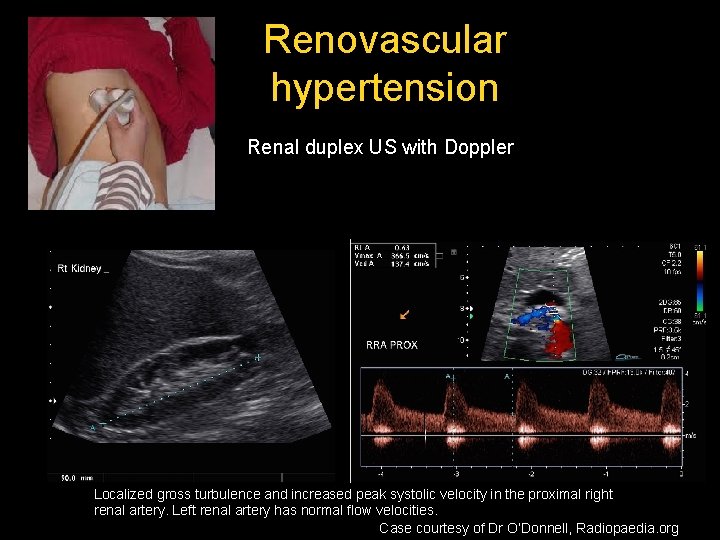 Renovascular hypertension Renal duplex US with Doppler Localized gross turbulence and increased peak systolic Renovascular hypertension Renal duplex US with Doppler Localized gross turbulence and increased peak systolic