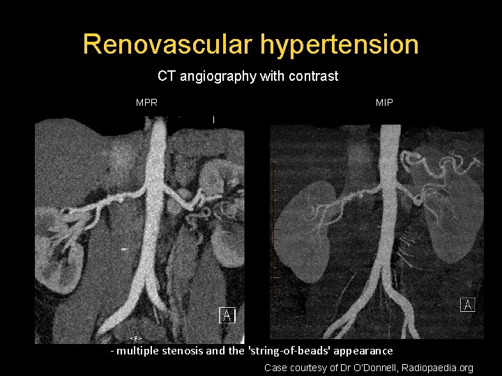 Renovascular hypertension CT angiography with contrast MPR MIP - multiple stenosis and the 'string-of-beads' Renovascular hypertension CT angiography with contrast MPR MIP - multiple stenosis and the 'string-of-beads'