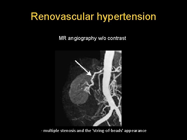 Renovascular hypertension MR angiography w/o contrast - multiple stenosis and the 'string-of-beads' appearance  Renovascular hypertension MR angiography w/o contrast - multiple stenosis and the 'string-of-beads' appearance