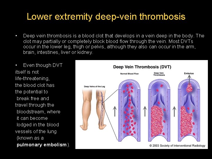 Lower extremity deep-vein thrombosis • Deep vein thrombosis is a blood clot that develops Lower extremity deep-vein thrombosis • Deep vein thrombosis is a blood clot that develops