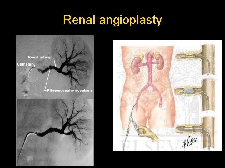 Renal angioplasty  Renal angioplasty