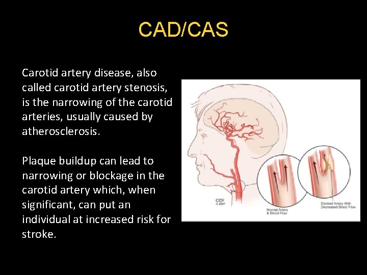 CAD/CAS Carotid artery disease, also called carotid artery stenosis, is the narrowing of the CAD/CAS Carotid artery disease, also called carotid artery stenosis, is the narrowing of the