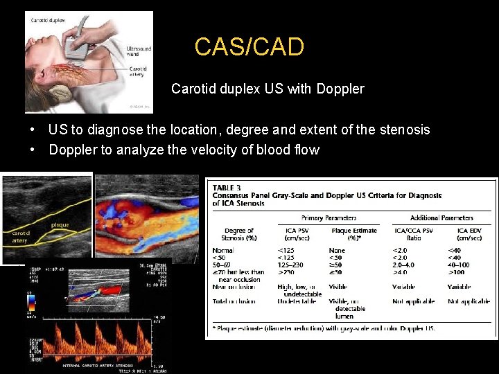 CAS/CAD Carotid duplex US with Doppler • US to diagnose the location, degree and CAS/CAD Carotid duplex US with Doppler • US to diagnose the location, degree and