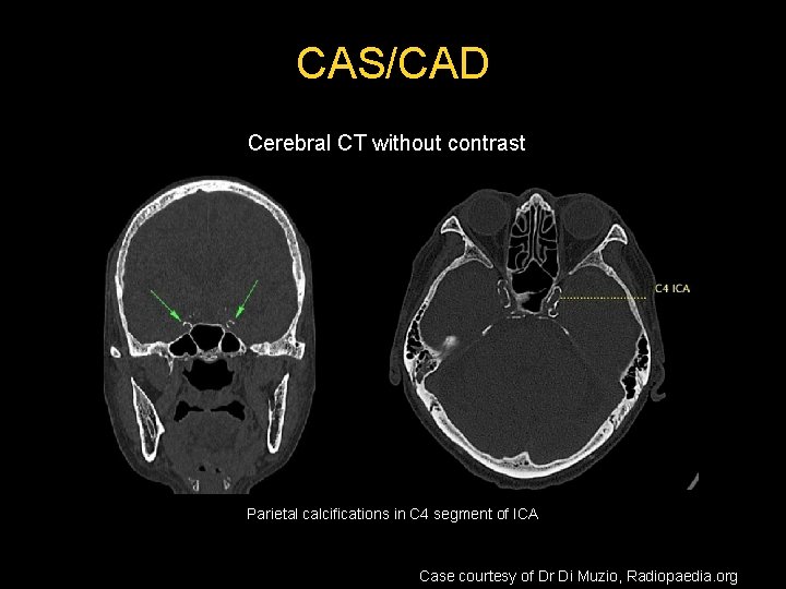 CAS/CAD Cerebral CT without contrast Parietal calcifications in C 4 segment of ICA Case CAS/CAD Cerebral CT without contrast Parietal calcifications in C 4 segment of ICA Case