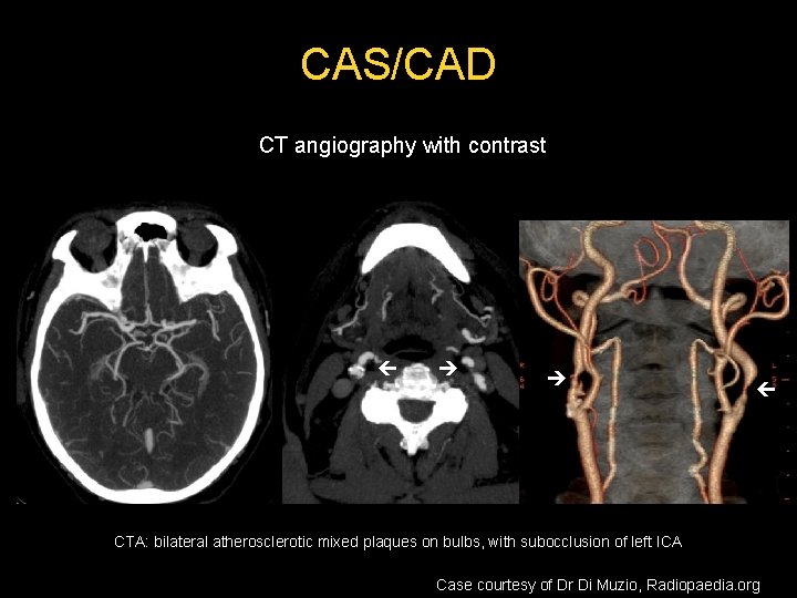 CAS/CAD CT angiography with contrast CTA: bilateral atherosclerotic mixed plaques on bulbs, with subocclusion CAS/CAD CT angiography with contrast CTA: bilateral atherosclerotic mixed plaques on bulbs, with subocclusion