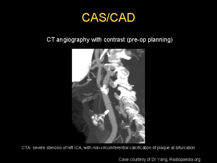 CAS/CAD CT angiography with contrast (pre-op planning) CTA: severe stenosis of left ICA, with CAS/CAD CT angiography with contrast (pre-op planning) CTA: severe stenosis of left ICA, with