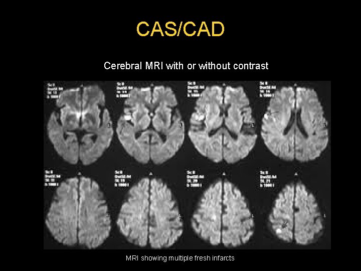 CAS/CAD Cerebral MRI with or without contrast MRI showing multiple fresh infarcts  CAS/CAD Cerebral MRI with or without contrast MRI showing multiple fresh infarcts