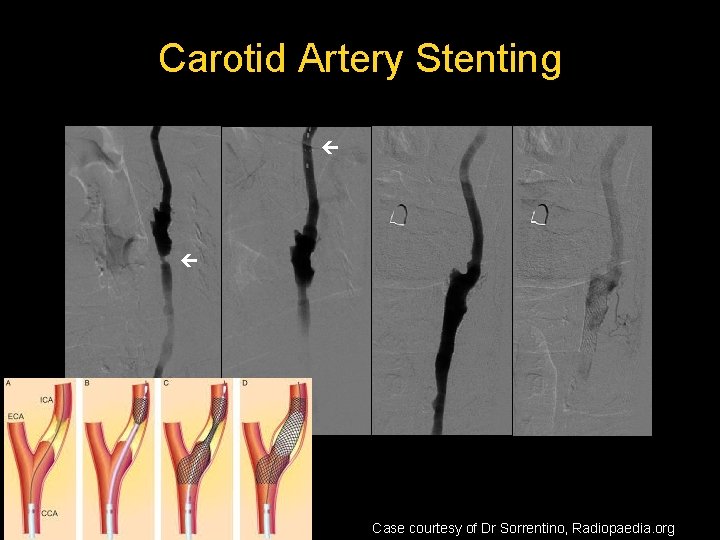 Carotid Artery Stenting Case courtesy of Dr Sorrentino, Radiopaedia. org  Carotid Artery Stenting Case courtesy of Dr Sorrentino, Radiopaedia. org