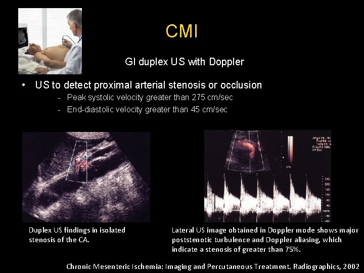 CMI GI duplex US with Doppler • US to detect proximal arterial stenosis or CMI GI duplex US with Doppler • US to detect proximal arterial stenosis or