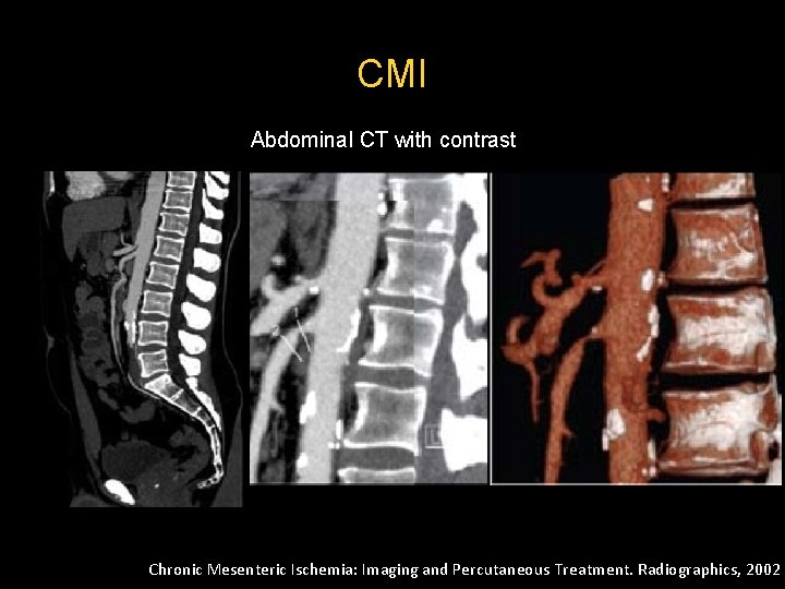 CMI Abdominal CT with contrast Chronic Mesenteric Ischemia: Imaging and Percutaneous Treatment. Radiographics, 2002 CMI Abdominal CT with contrast Chronic Mesenteric Ischemia: Imaging and Percutaneous Treatment. Radiographics, 2002