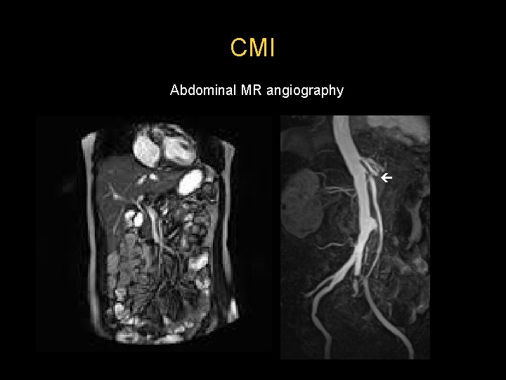 CMI Abdominal MR angiography  CMI Abdominal MR angiography