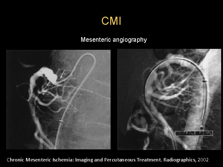 CMI Mesenteric angiography Chronic Mesenteric Ischemia: Imaging and Percutaneous Treatment. Radiographics, 2002  CMI Mesenteric angiography Chronic Mesenteric Ischemia: Imaging and Percutaneous Treatment. Radiographics, 2002