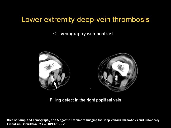 Lower extremity deep-vein thrombosis CT venography with contrast • Filling defect in the right Lower extremity deep-vein thrombosis CT venography with contrast • Filling defect in the right