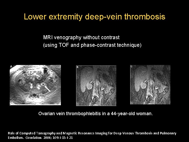 Lower extremity deep-vein thrombosis MRI venography without contrast (using TOF and phase-contrast technique) Ovarian Lower extremity deep-vein thrombosis MRI venography without contrast (using TOF and phase-contrast technique) Ovarian