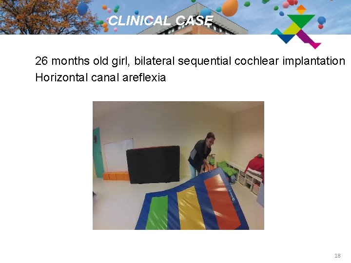 CLINICAL CASE 26 months old girl, bilateral sequential cochlear implantation Horizontal canal areflexia 18