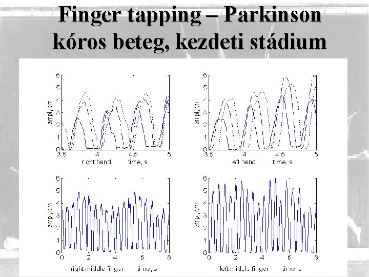 Finger tapping – Parkinson kóros beteg, kezdeti stádium 