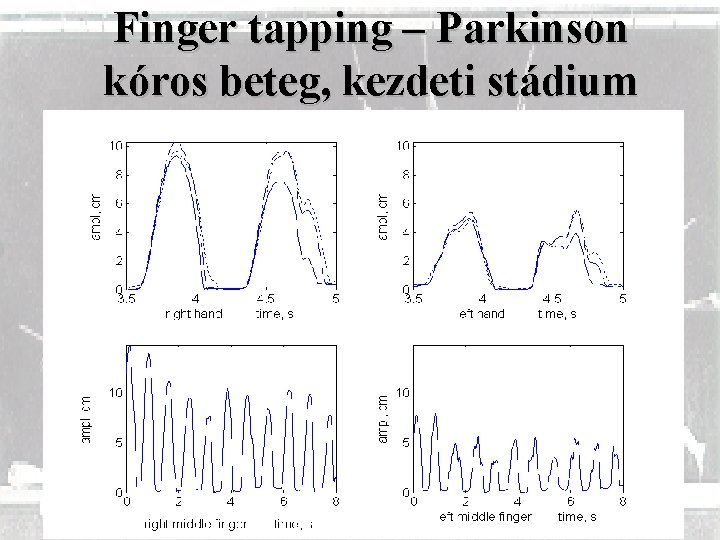 Finger tapping – Parkinson kóros beteg, kezdeti stádium 