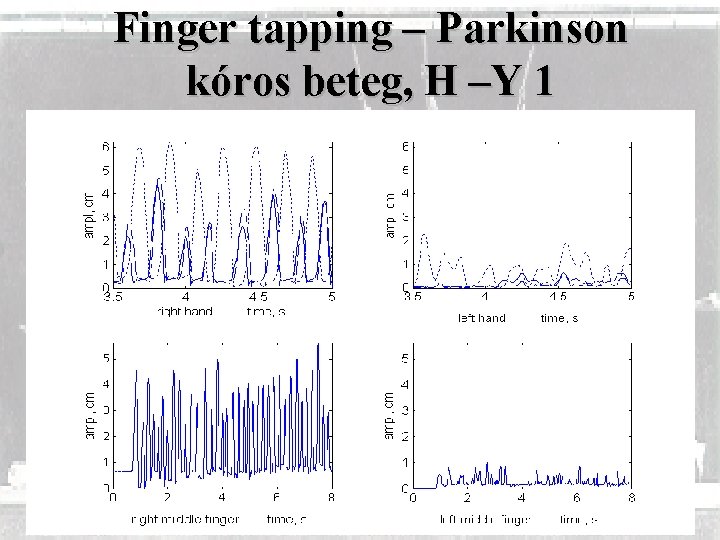 Finger tapping – Parkinson kóros beteg, H –Y 1 