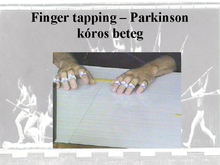 Finger tapping – Parkinson kóros beteg 