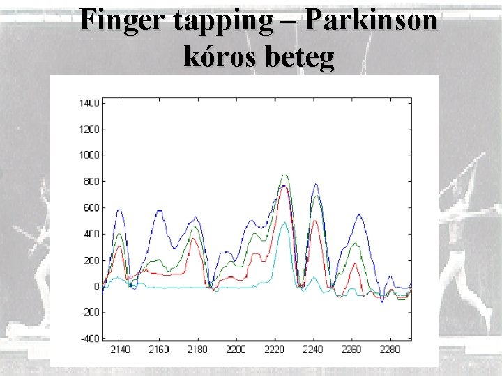 Finger tapping – Parkinson kóros beteg 