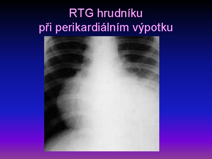 RTG hrudníku při perikardiálním výpotku 