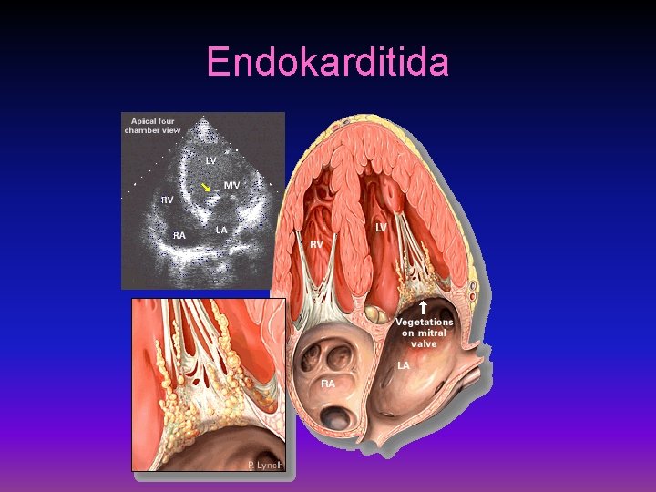 Endokarditida 