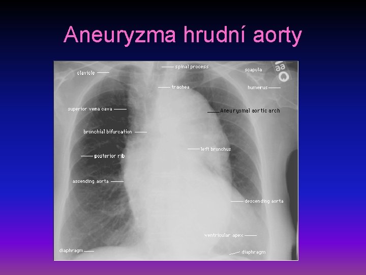 Aneuryzma hrudní aorty 