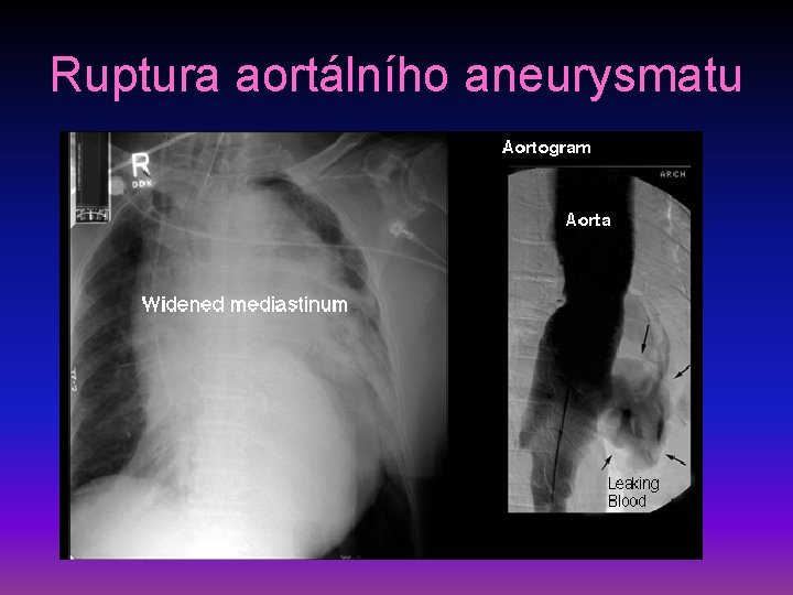 Ruptura aortálního aneurysmatu 