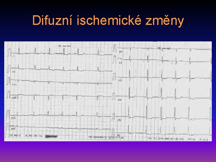 Difuzní ischemické změny 