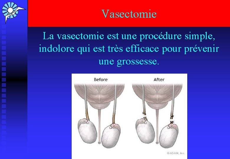 Vasectomie La vasectomie est une procédure simple, indolore qui est très efficace pour prévenir