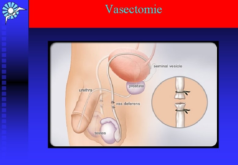 Vasectomie 