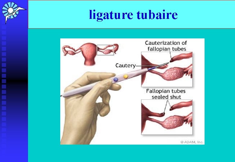 ligature tubaire 