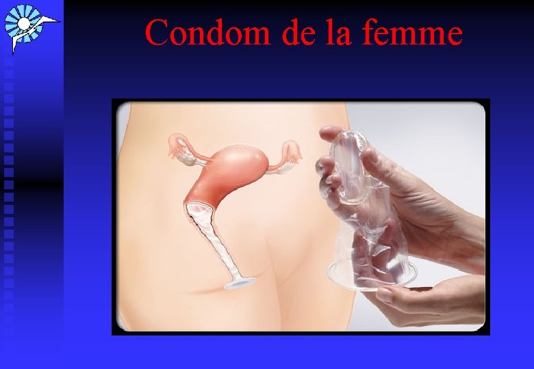  Condom de la femme 