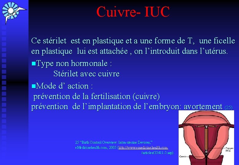 Cuivre- IUC Ce stérilet est en plastique et a une forme de T, une