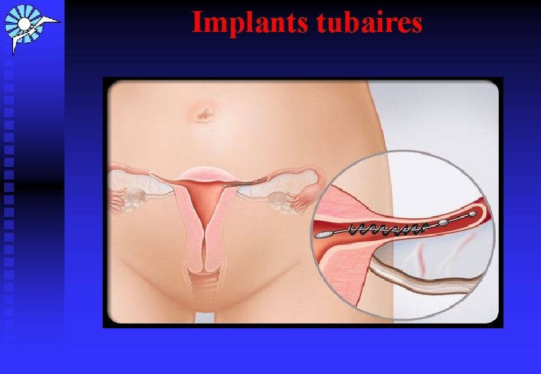 Implants tubaires 